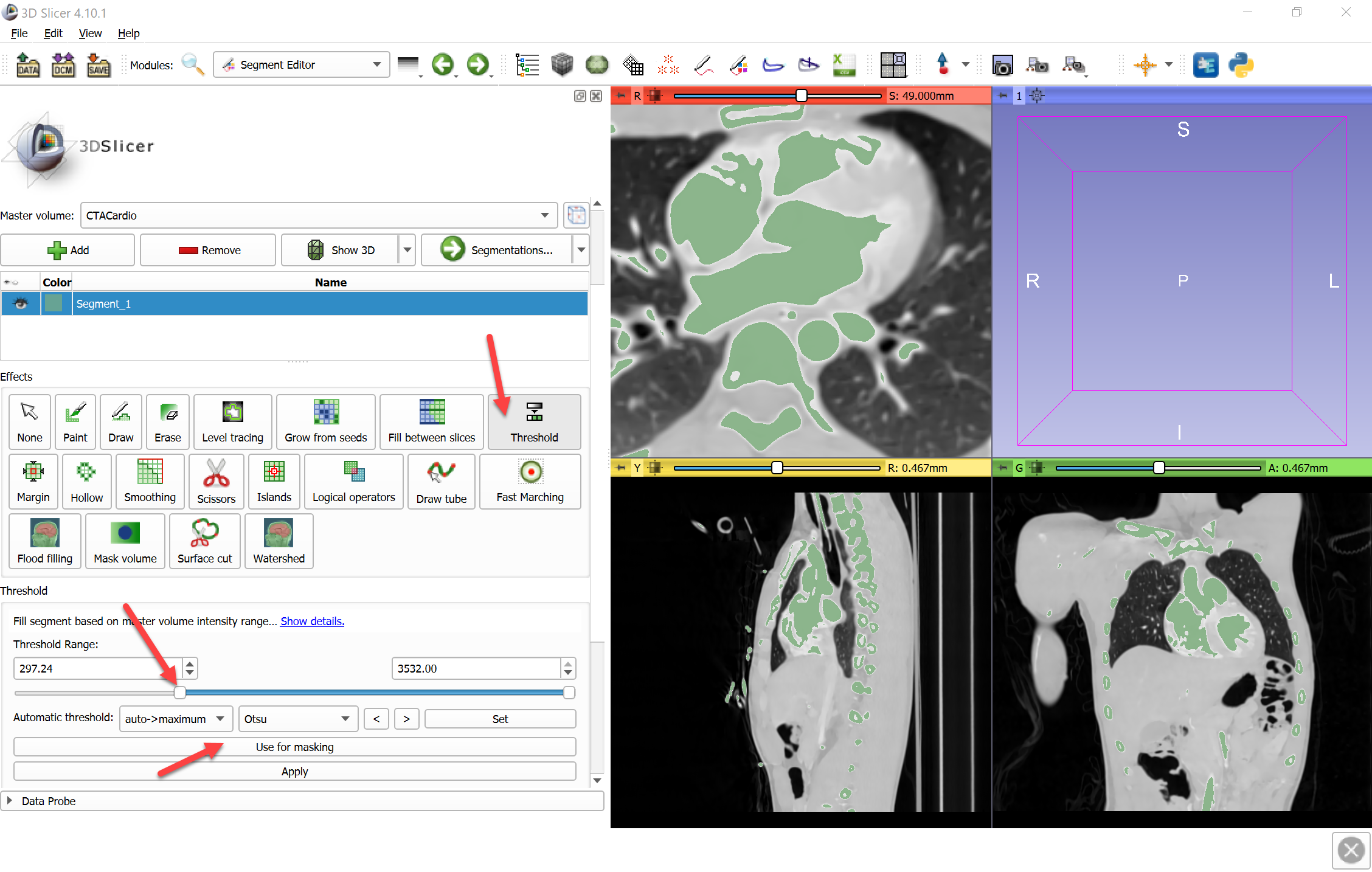 Overview 3d Slicer Segmentation Recipes