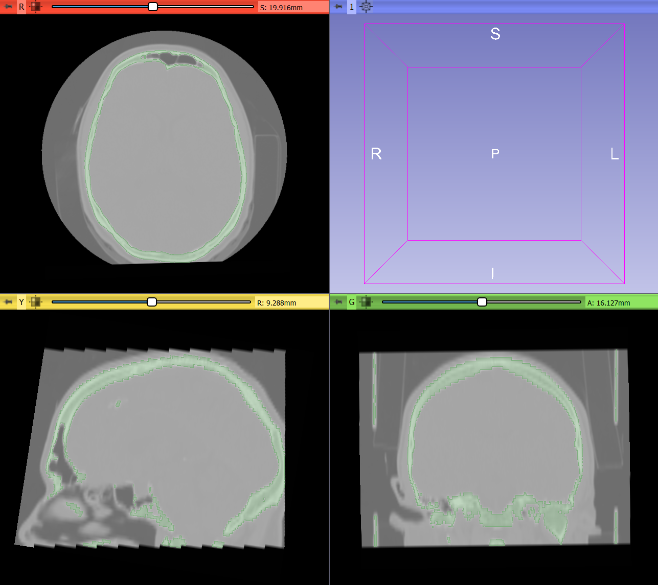 Segment containing skull bone.