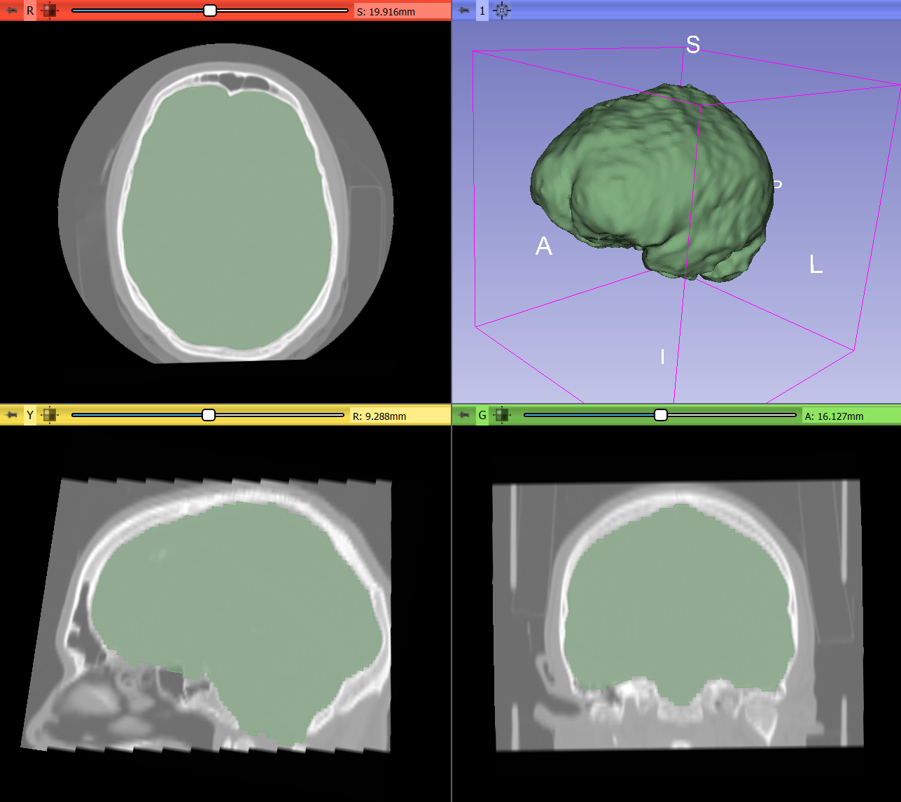 Solid brain cavity segment.