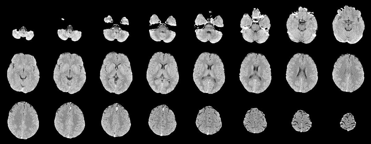 Skull-stripped CT image.