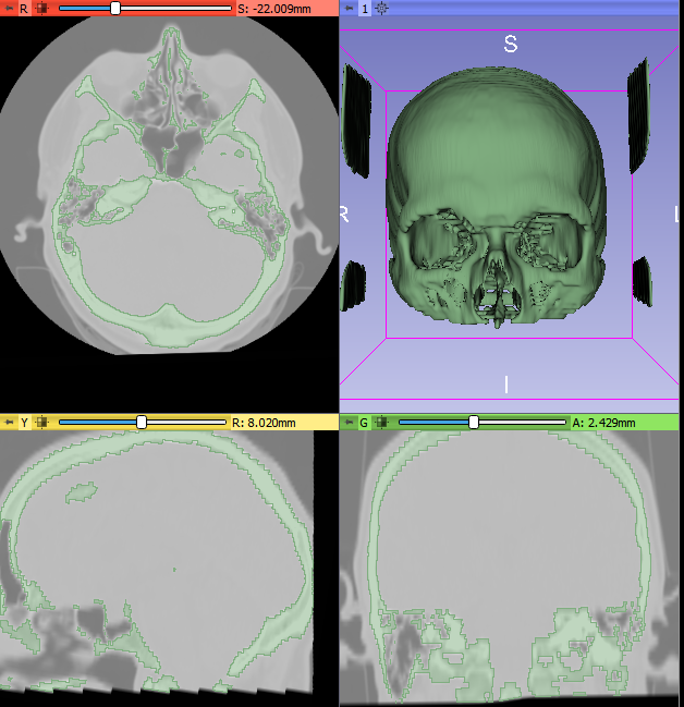 Skull visible in 3D viewer.