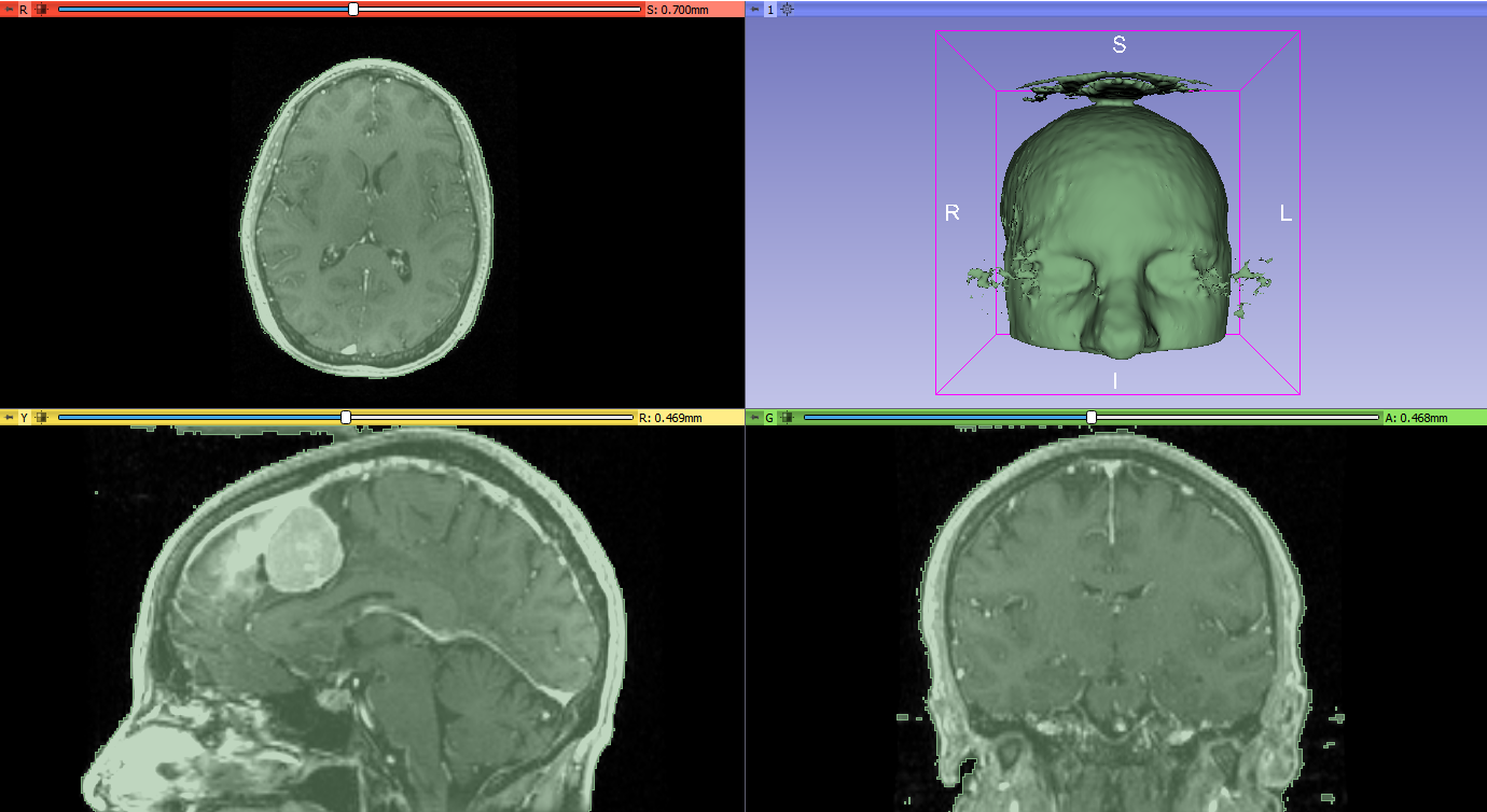 Inverted air segment is tissue segment.