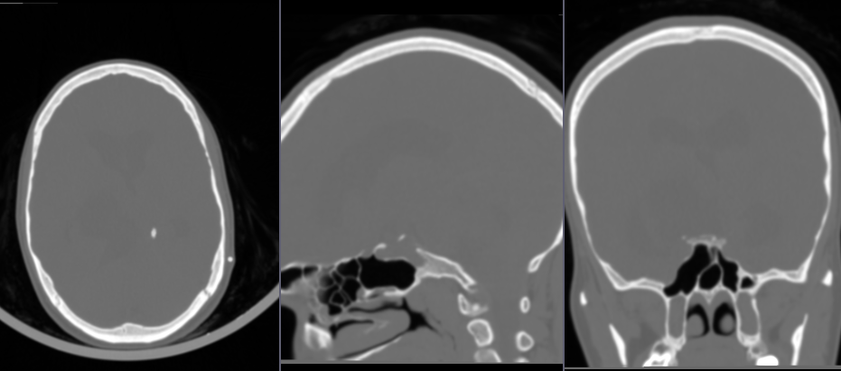Fading between baseline and aligned contrast images. Patient motion is reduced.