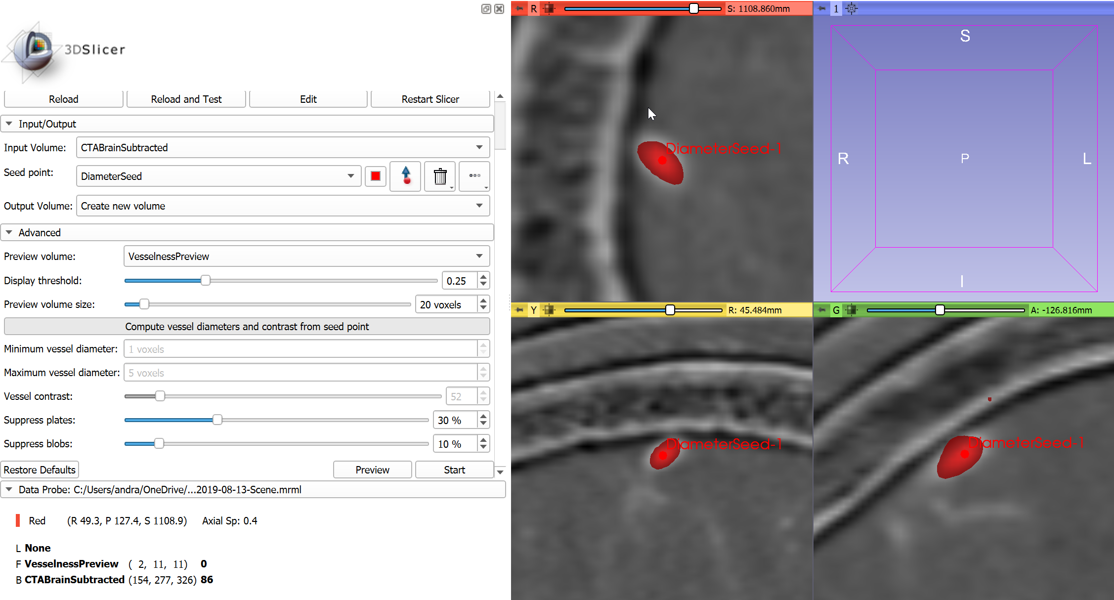 Vesselness filtering preview - with increased plate suppression